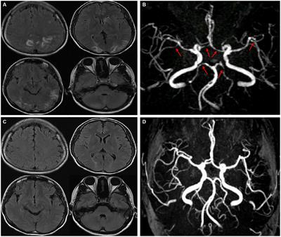 Reversible cerebral vasoconstriction syndrome following intracranial hypotension in a postpartum patient: a case report and literature review